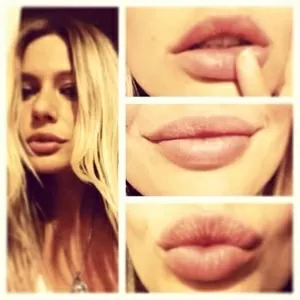 Контурная пластика лица,  увеличение губ,  увеличение скул,  коррекция формы